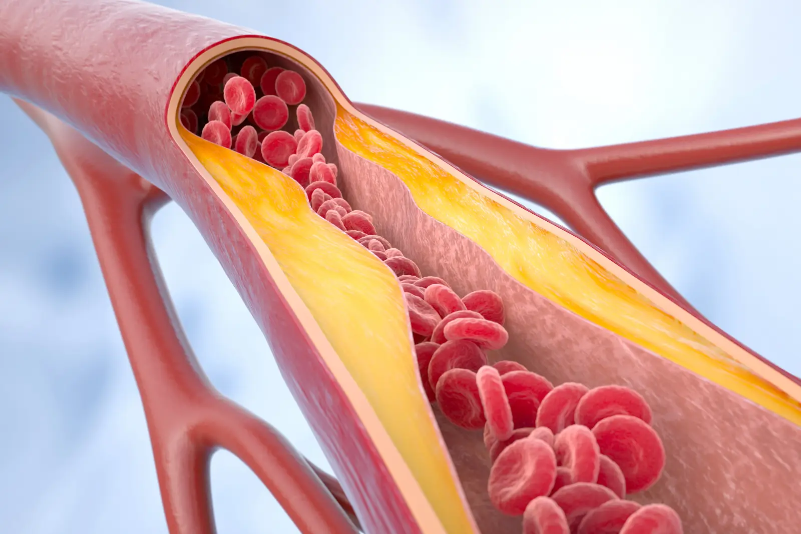 Illustration of an artery cut open to show yellow plaque narrowing the channel that red blood cells flow through.