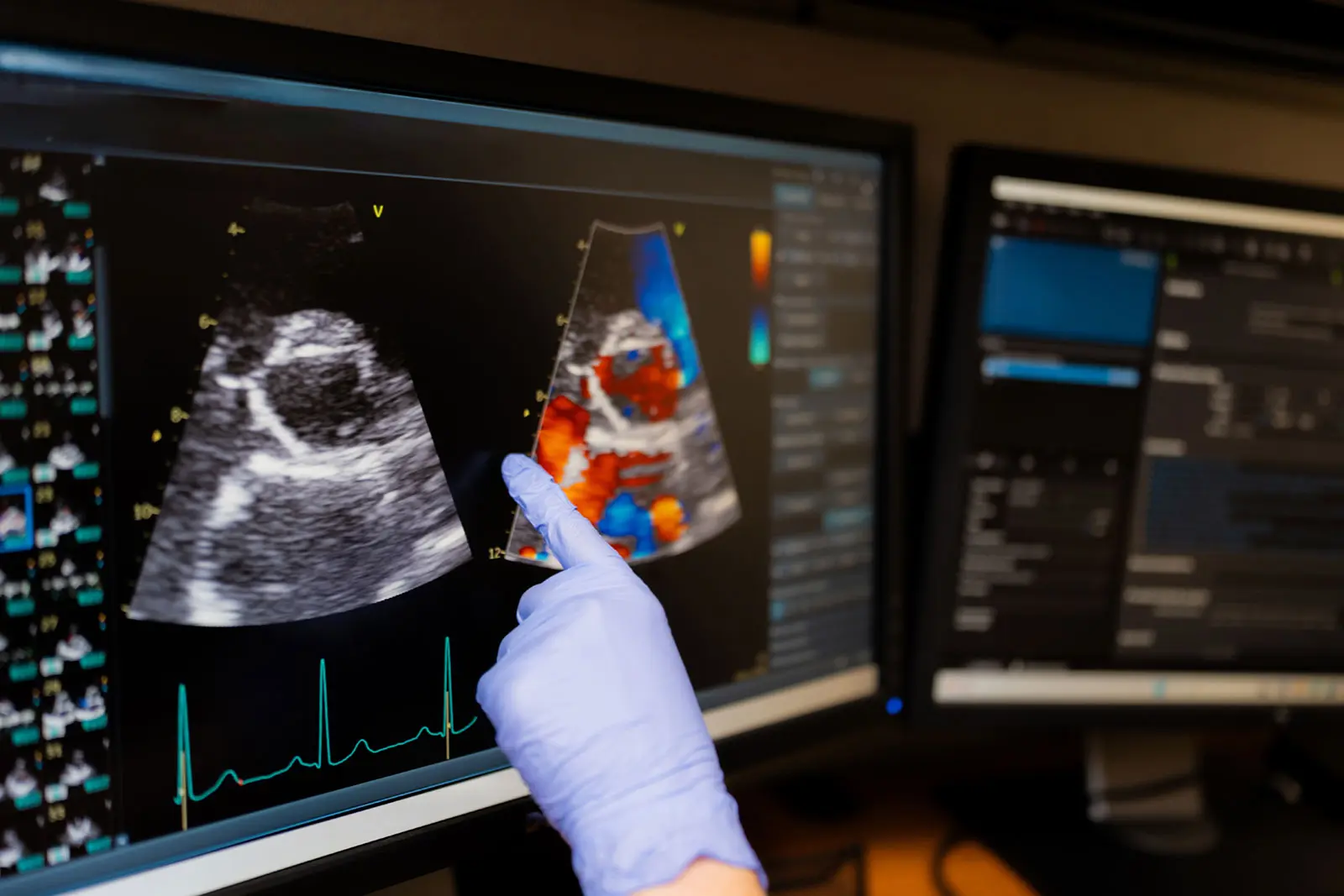 A cardiologist reviewing a Doppler echocardiogram study on screen
